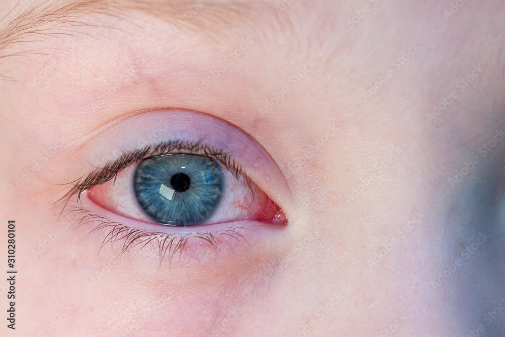 Obraz premium Closeup of irritated red bloodshot eye - conjunctivitis