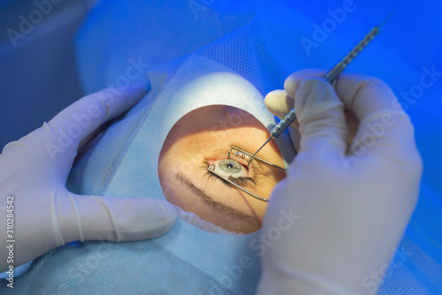 A close-up of the work of an ophthalmologist, behind the laser eye microsurgery apparatus. A doctor using a microsurgical instrument performs an operation on the patients eyes photo