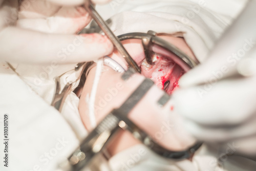 hands of a dentist doctor, closeup. The operation to eliminate the defect of the cleft palate, pathology of the hard palate. The child's mouth is open by the conservative, a bloody wound, gaping.