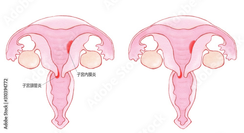 子宮膣管炎-子宮内膜炎 photo