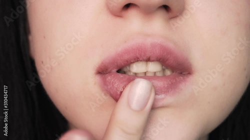 Girl smears ointment lips. Dry skin in the cold season. Disease and lack of vitamins. photo