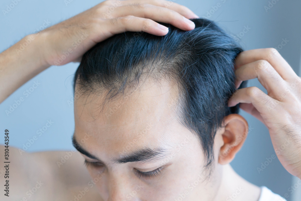 Young man serious hair loss problem for health care medical and shampoo product concept, selective focus Young man serious hair loss problem for health care medical and shampoo product concept, selective focus