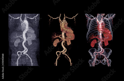 Foto collection of CTA abdominal aorta 3D rendering image showing aortic dissection