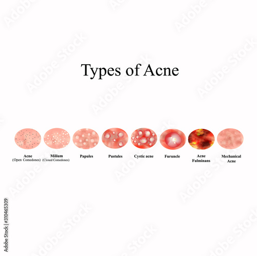 Types of Acne Skin inflammation. Pimples, boils, whitehead, closed comedones, papules, pustules, cystic acne. Infographics. Vector illustration on isolated background.
