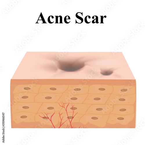 Atrophic scars. Acne scar. The anatomical structure of the skin with acne. Vector illustration on isolated background.