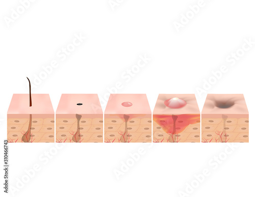 Treatment of open comedones, inflamed acne, acne cysts. Sore acne. structure of the skin. Treatment of scars of acne and pimples. blackheads. Infographics. Vector illustration on isolated background.