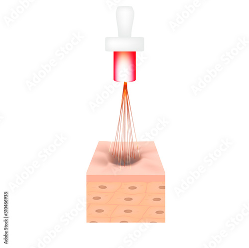 Acne scars. Laser scar atrophic treatment. The anatomical structure of the skin with acne. Vector illustration on isolated background.