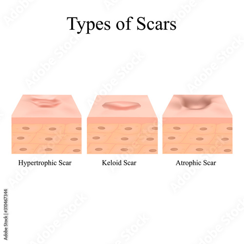 Types of scars. Acne scars. Keloid, hypertrophic, atrophic, normotrophic. The anatomical structure of the skin with acne. Vector illustration on isolated background.