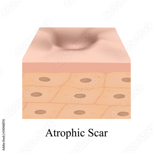 Atrophic scars. Acne scar. The anatomical structure of the skin with acne. Vector illustration on isolated background.