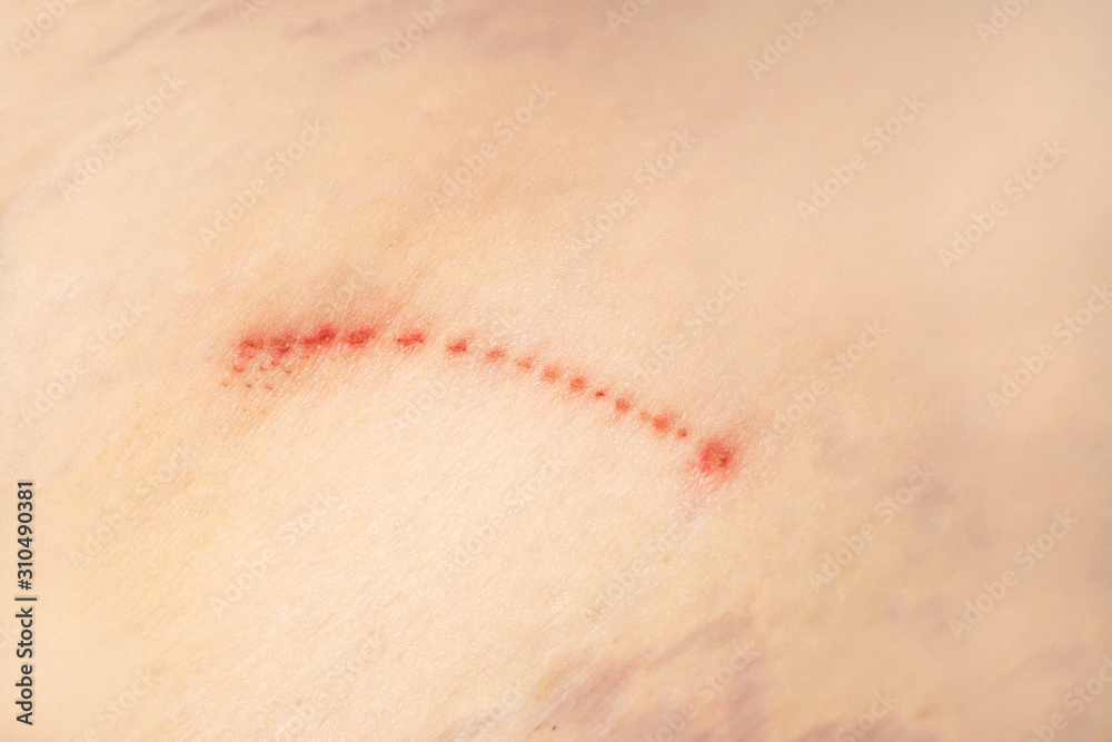 Fototapeta premium Skin damage, macro: scratch, stretch marks, age spots. Texture of damaged skin