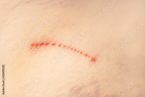 Skin damage, macro: scratch, stretch marks, age spots. Texture of damaged skin