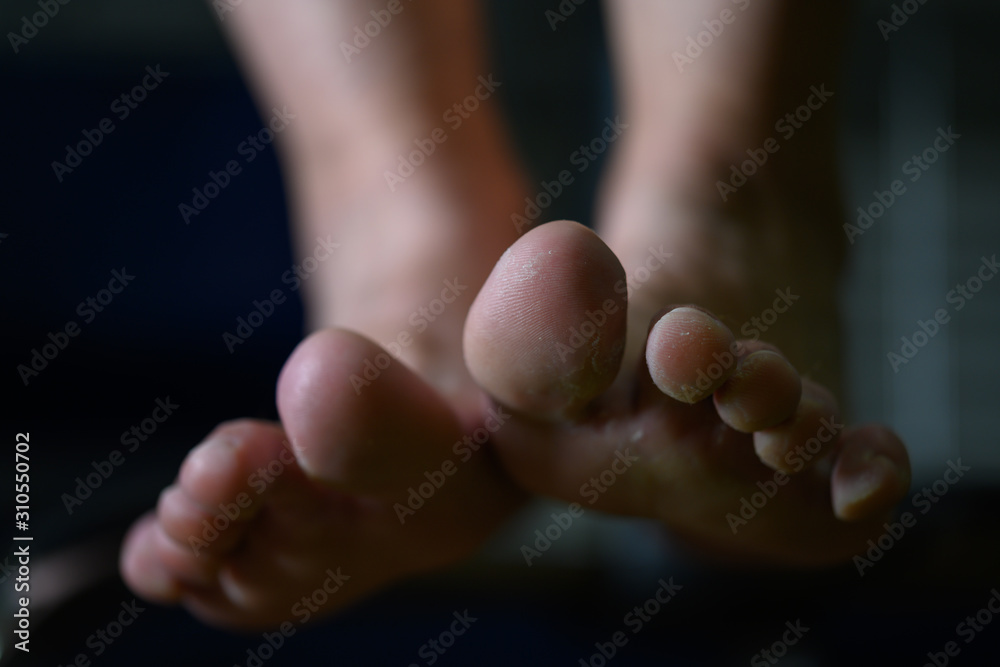 Close up of woman feet having tinea pedis althlete's fungus infection Close up of woman feet having tinea pedis althlete's fungus infection