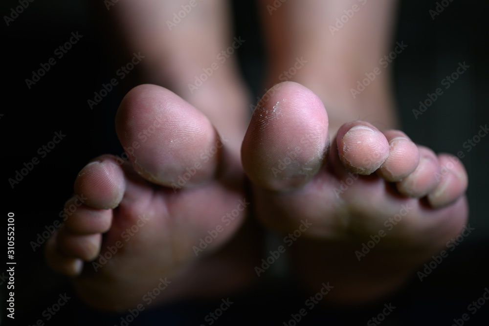 Close up of woman feet having tinea pedis althlete's fungus infection Close up of woman feet having tinea pedis althlete's fungus infection
