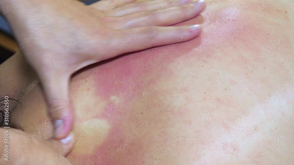 Red spots on the skin of the lady while being massage Red spots on the skin of the lady while being massage