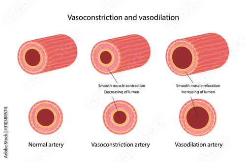 Arterial vasoconstriction and vasodilation. Comparison illustration of normal, constricted, and dilated blood vessels. Diagram with description of the main parts. Vector illustration photo