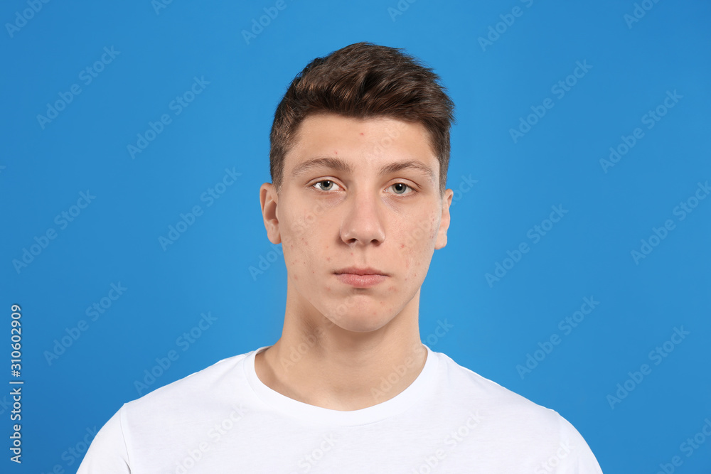 Fototapeta premium Teen guy with acne problem on blue background