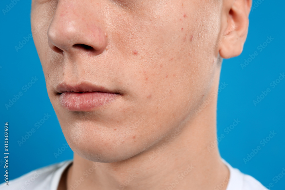 Teen guy with acne problem on blue background, closeup