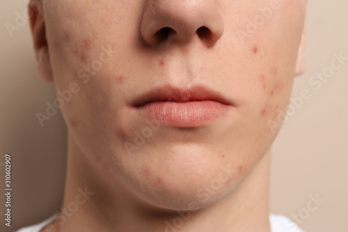 Teen guy with acne problem on beige background, closeup