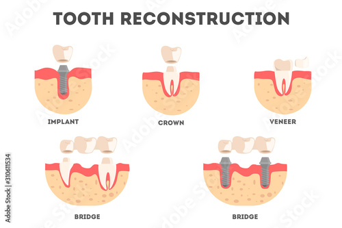 Set of diffrent human teeth reconstruction kind. Tooth loss and repacement.