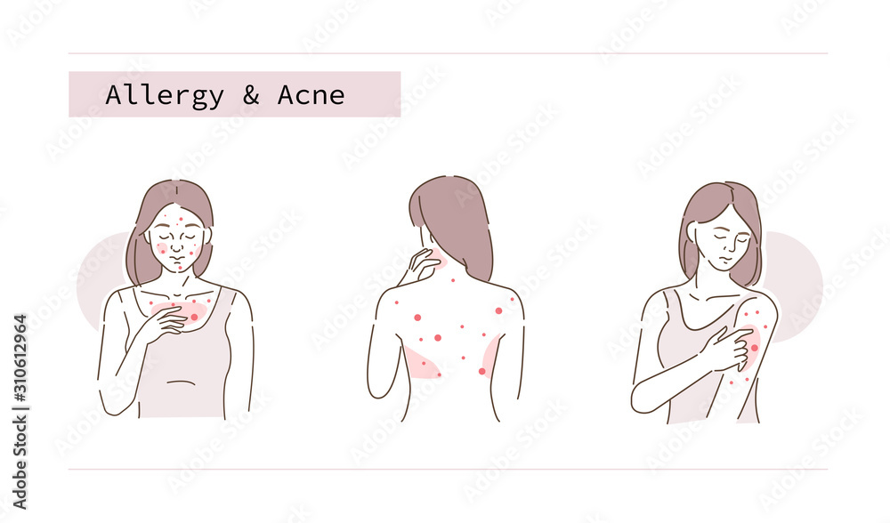Beauty Girl Have Allergy and Acne Skin Problems. Woman Scratching her Body and Face with Hand. Allergic Dermatitis, Eczema or Nettle Rash with Itch Symptoms. Flat Line Cartoon Vector Illustration. Beauty Girl Have Allergy and Acne Skin Problems. Woman Scratching her Body and Face with Hand. Allergic Dermatitis, Eczema or Nettle Rash with Itch Symptoms. Flat Line Cartoon Vector Illustration.