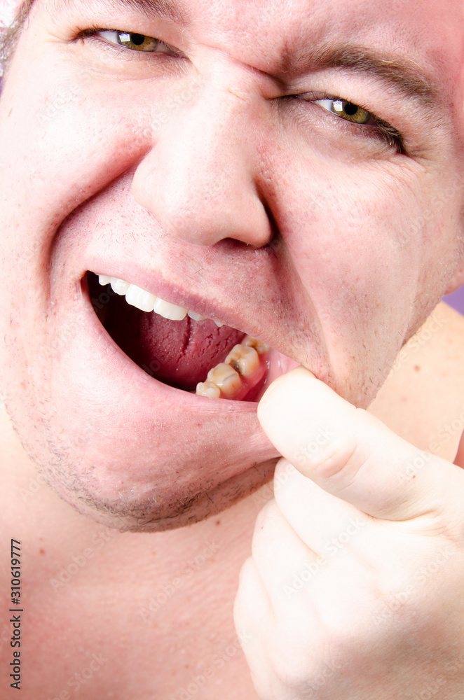 Naklejka premium Caries. Funny fat guy is brushing his teeth.