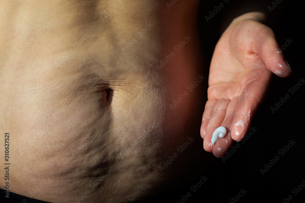 Woman smears cream sagging flabby belly with stretch marks. Woman smears cream sagging flabby belly with stretch marks.