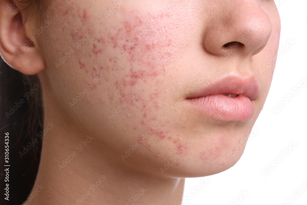 Teenage girl with acne problem on white background, closeup Teenage girl with acne problem on white background, closeup