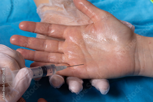 Quadro em tela Botulinum toxin in the treatment of hyperidrosis: concept of neurotoxin in the t