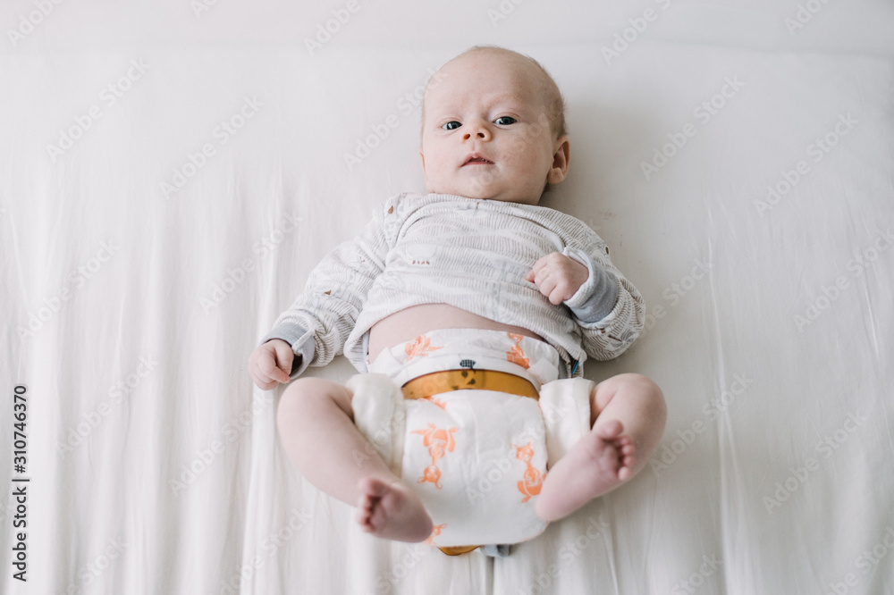 Baby with Hip Dysplasia Stock Photo Adobe Stock