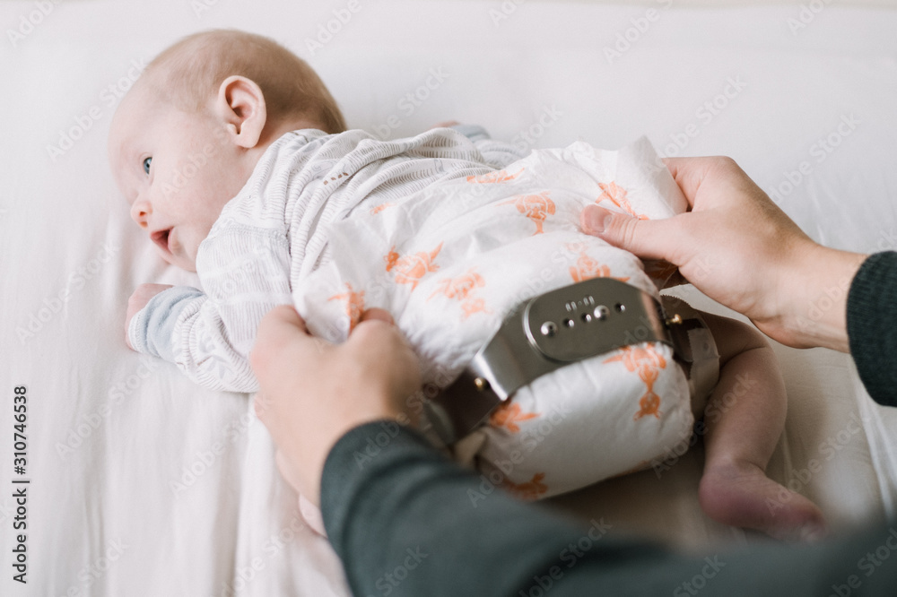 Baby with Hip Dysplasia Stock Photo Adobe Stock