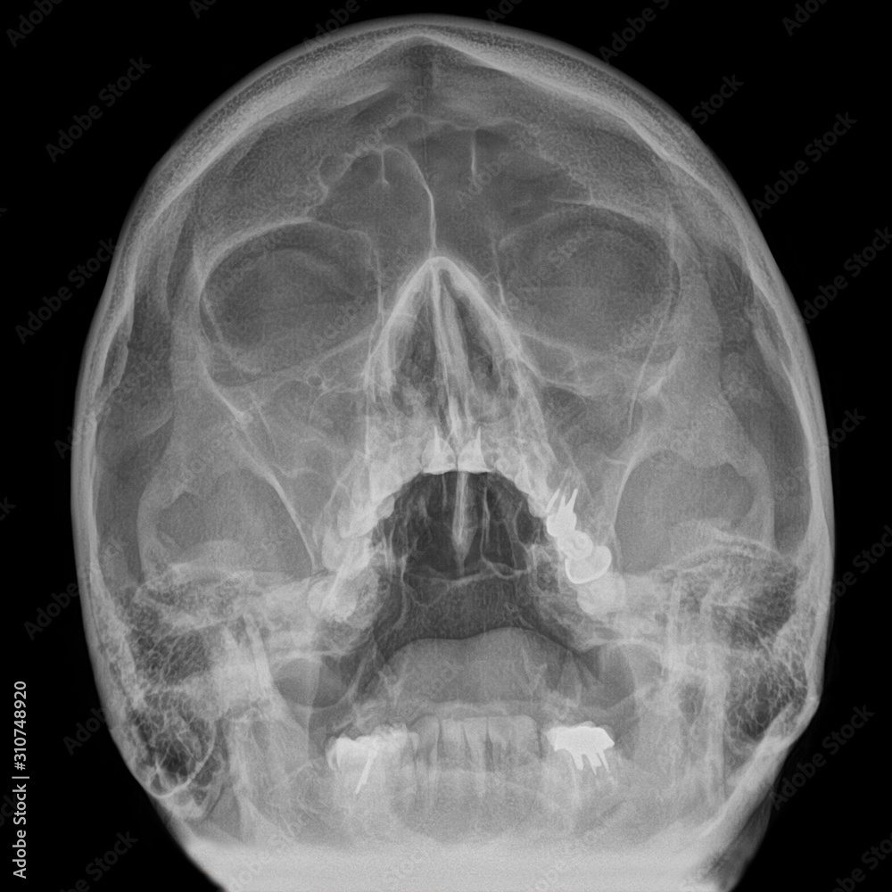 Adult skull radiography Stock Photo Adobe Stock