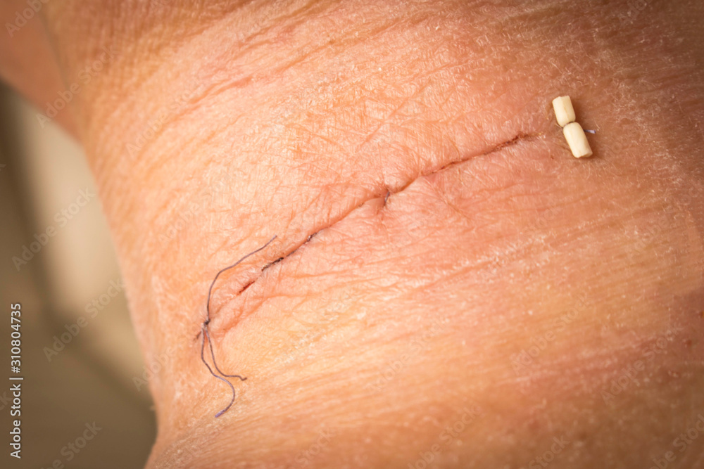 Fototapeta premium Suture after surgery on the human neck. Stitched wound after surgery. Close up.
