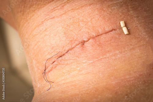 Suture after surgery on the human neck. Stitched wound after surgery. Close up.