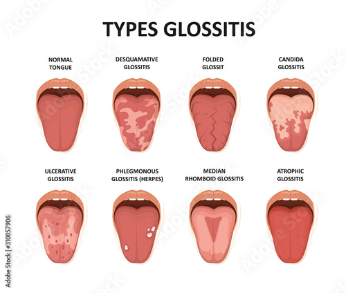 Types glossitis. Tongue disease illustration