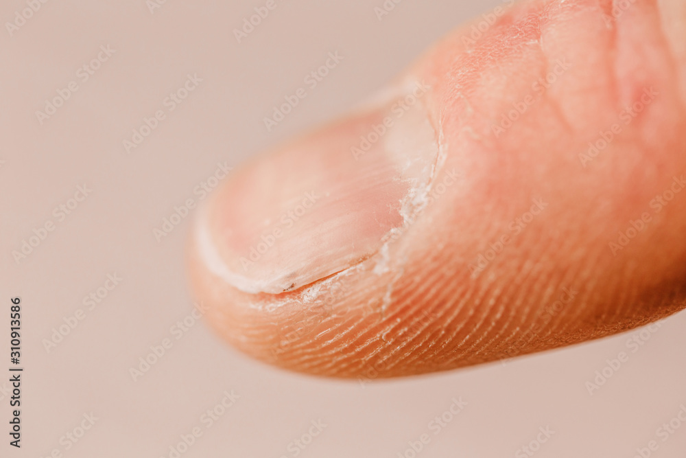 Damaged fingernail and dry skin - rough working hands Damaged fingernail and dry skin - rough working hands
