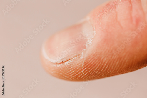 Damaged fingernail and dry skin - rough working hands