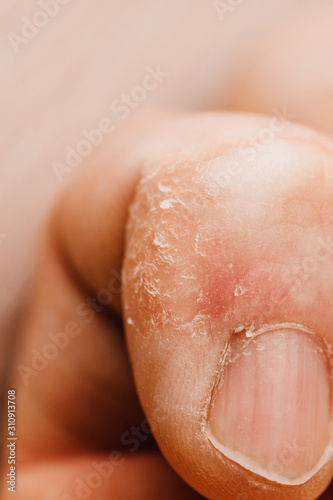 Dry skin on the little finger close up - problem skin - dermatology
