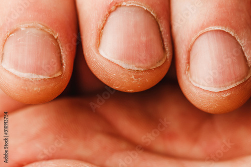 bad uneven nails with damaged cuticles - close-up macro