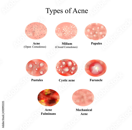 Types of Acne Skin inflammation. Pimples, boils, whitehead, closed comedones, papules, pustules, cystic acne. Infographics. Vector illustration on isolated background.