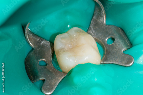 restoration of the tooth with photopolymer filling close-up macro. Caries