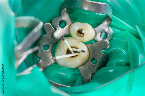 human tooth close-up macro. Endodontics treatment of canals and pulp of a tooth. Pulpitis photo