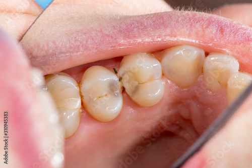 Caries and tooth disease. Filling with a dental composite photopolymer material using Rubber Dam. The concept of dental treatment in the dental clinic