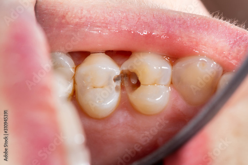 Caries and tooth disease. Filling with a dental composite photopolymer material using Rubber Dam. The concept of dental treatment in the dental clinic photo