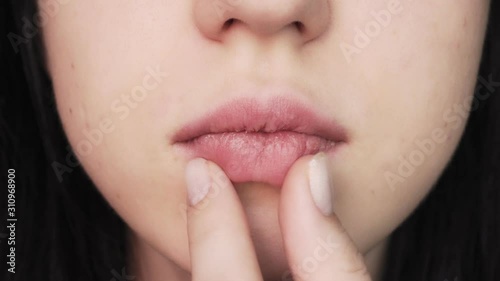 Lips of a young girl close-up. Dry and cracked lips. Illness and vitamin deficiency.