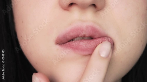 Lips of a young girl close-up. Dry and cracked lips. Illness and vitamin deficiency.