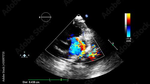 Image of the heart during transesophageal ultrasound with Doppler mode.