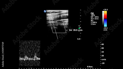 Pulse wave Doppler ultrasound examination of vessels.