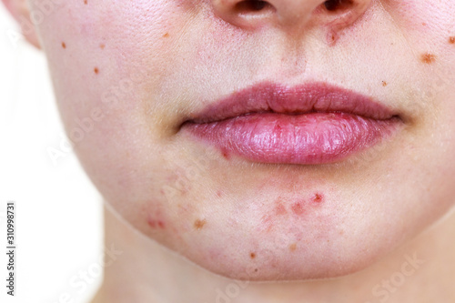 Female face with acne skin problem