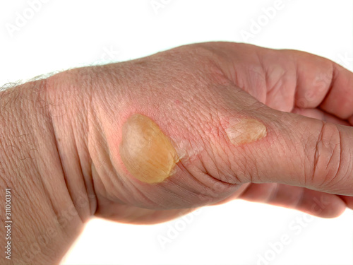 A man burned his hand with hot oil. It is a second degree burn. Concept: skin burns