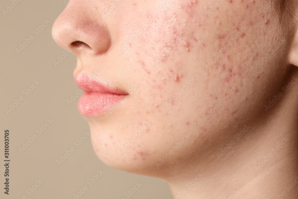 Teenage girl with acne problem on beige background, closeup Teenage girl with acne problem on beige background, closeup